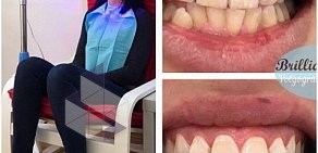 Студия косметического отбеливания зубов BrilliantSmile