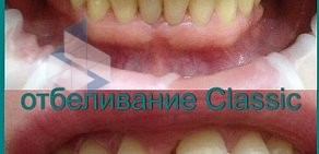 Безопасное отбеливание зубов Smile Boutique