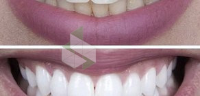 Студия косметического отбеливания зубов White&Smile на улице Маросейка 